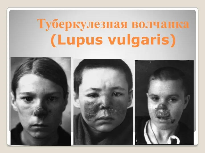Туберкулезная волчанка (Lupus vulgaris)