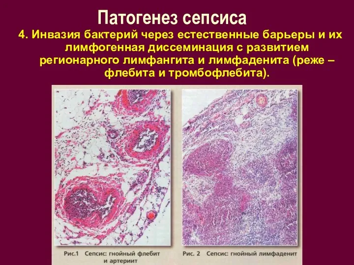 Патогенез сепсиса 4. Инвазия бактерий через естественные барьеры и их лимфогенная диссеминация с