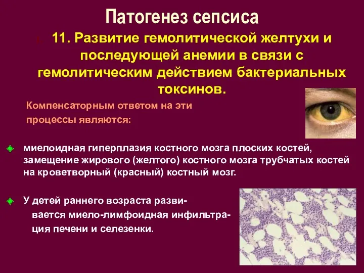 Патогенез сепсиса 11. Развитие гемолитической желтухи и последующей анемии в связи с гемолитическим