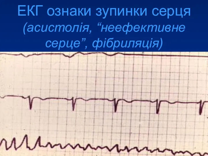 ЕКГ ознаки зупинки серця (асистолія, “неефективне серце”, фібриляція)