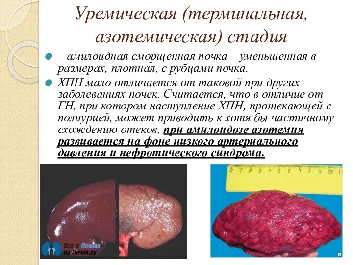 Уремическая (терминальная, азотемическая) стадия – амилоидная сморщенная почка – уменьшенная