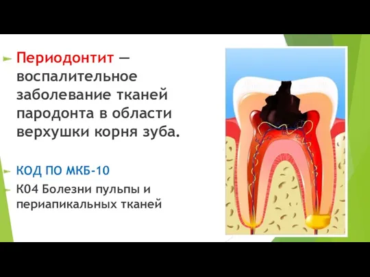 Периодонтит — воспалительное заболевание тканей пародонта в области верхушки корня зуба. КОД ПО