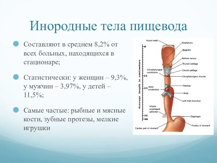 Инородные тела пищевода Составляют в среднем 8,2% от всех больных,