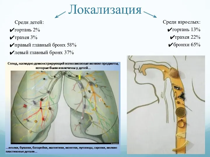 Локализация Среди детей: гортань 2% трахея 3% правый главный бронх