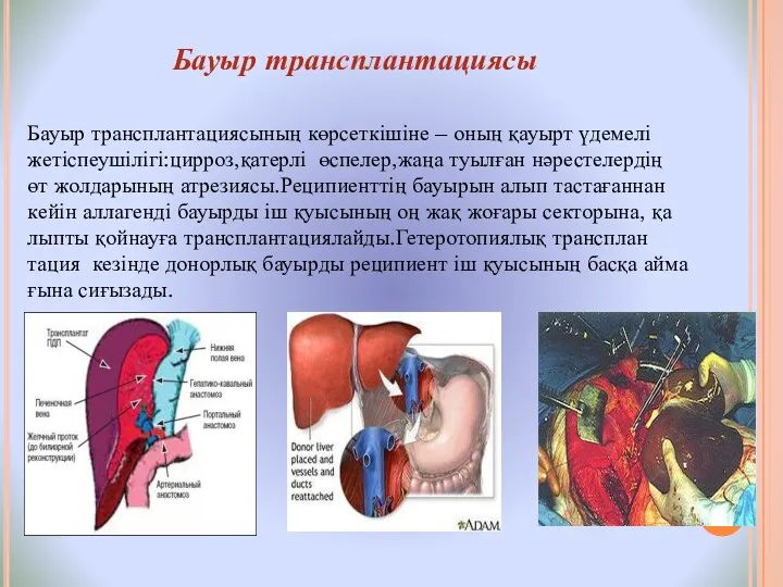 Бауыр трансплантациясы Бауыр трансплантациясының көрсеткішіне – оның қауырт үдемелі жетіспеушілігі:цирроз,қатерлі