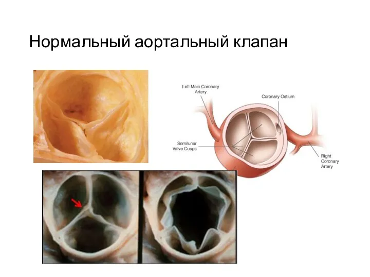 Нормальный аортальный клапан