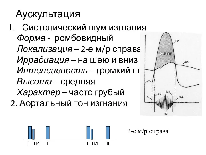 Аускультация Систолический шум изгнания Форма - ромбовидный Локализация – 2-е