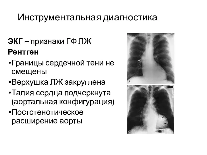 Инструментальная диагностика ЭКГ – признаки ГФ ЛЖ Рентген Границы сердечной