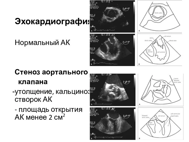 Эхокардиография Нормальный АК Стеноз аортального клапана утолщение, кальциноз створок АК