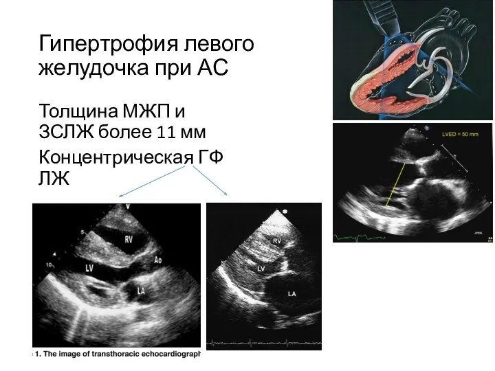Гипертрофия левого желудочка при АС Толщина МЖП и ЗСЛЖ более 11 мм Концентрическая ГФ ЛЖ