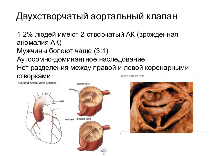 Двухстворчатый аортальный клапан 1-2% людей имеют 2-створчатый АК (врожденная аномалия