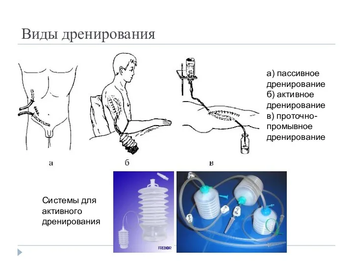 Виды дренирования а) пассивное дренирование б) активное дренирование в) проточно-промывное дренирование Системы для активного дренирования