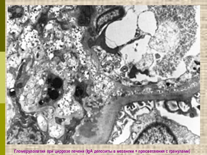 Гломерулопатия при циррозе печени (IgА депозиты в мезангии + просветления с гранулами)