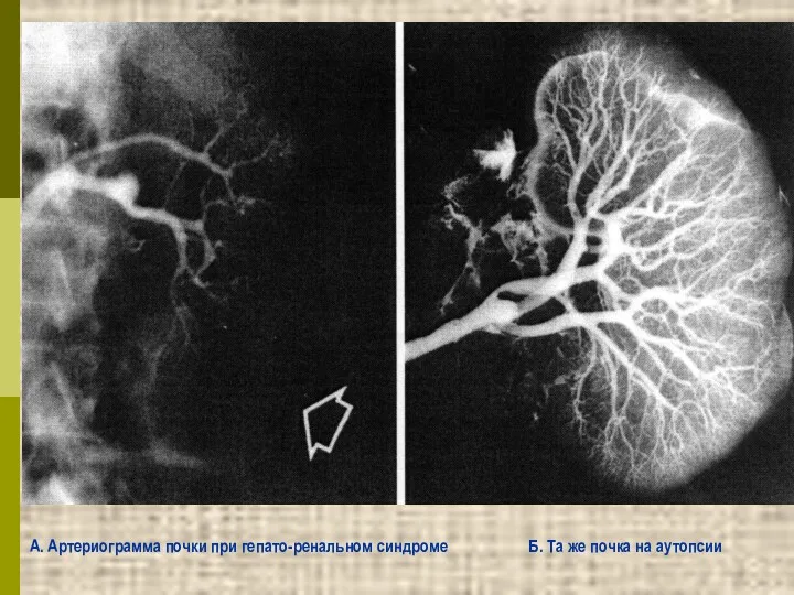 А. Артериограмма почки при гепато-ренальном синдроме Б. Та же почка на аутопсии