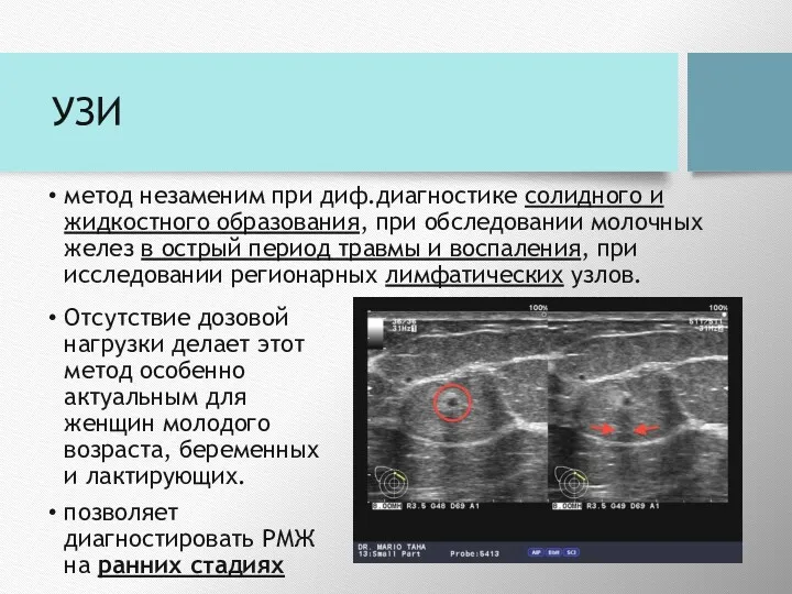 УЗИ метод незаменим при диф.диагностике солидного и жидкостного образования, при