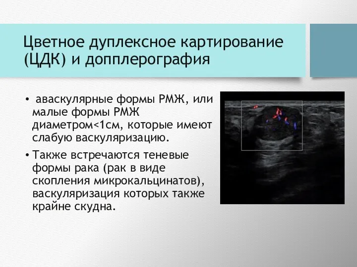 Цветное дуплексное картирование (ЦДК) и допплерография аваскулярные формы РМЖ, или