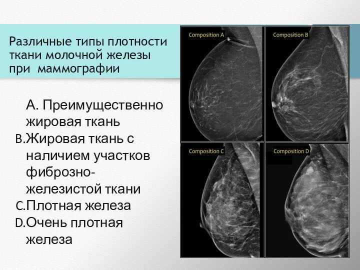 Различные типы плотности ткани молочной железы при маммографии А. Преимущественно