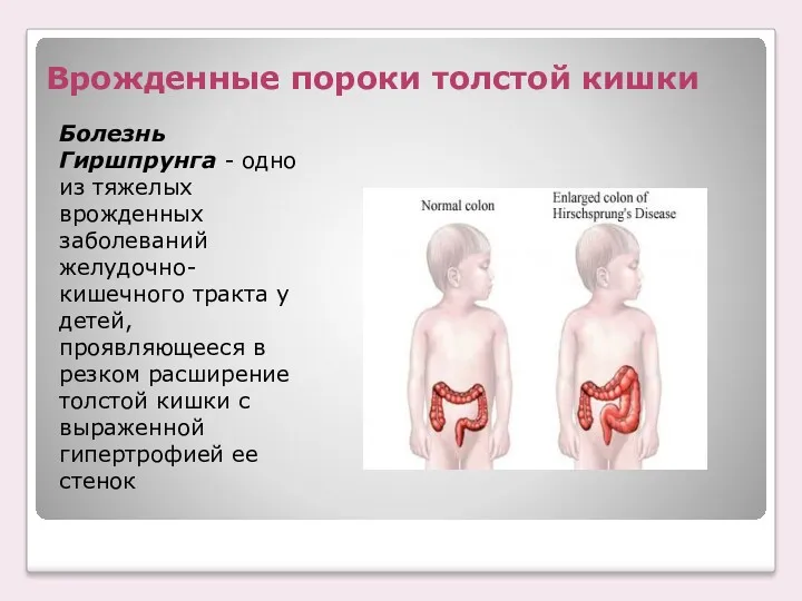 Врожденные пороки толстой кишки Болезнь Гиршпрунга - одно из тяжелых