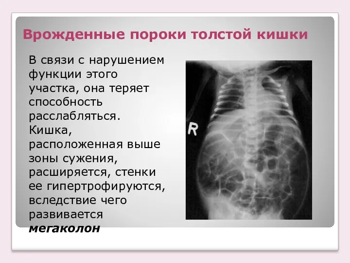 Врожденные пороки толстой кишки В связи с нарушением функции этого