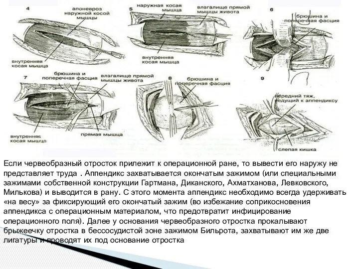 Если червеобразный отросток прилежит к операционной ране, то вывести его