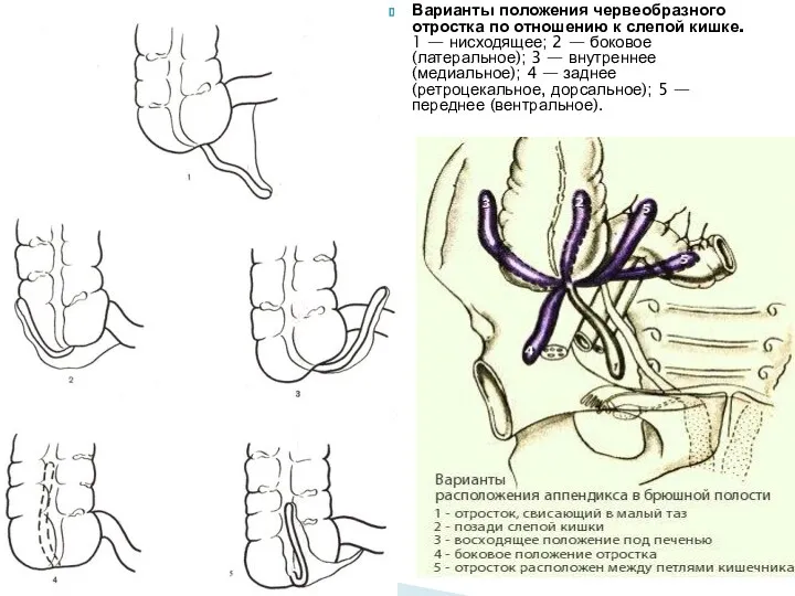 Варианты положения червеобразного отростка по отношению к слепой кишке. 1