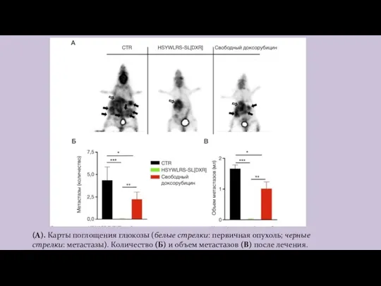 (A). Карты поглощения глюкозы (белые стрелки: первичная опухоль; черные стрелки: метастазы). Количество (Б)