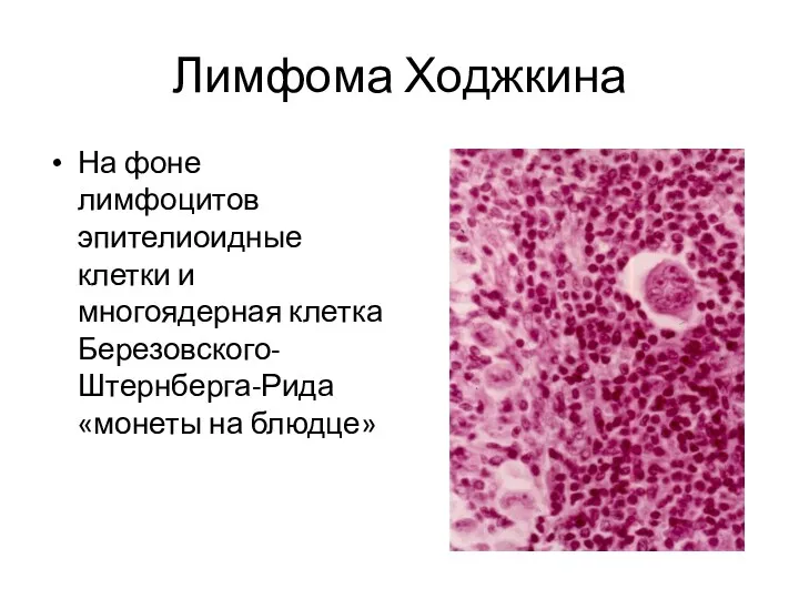 Лимфома Ходжкина На фоне лимфоцитов эпителиоидные клетки и многоядерная клетка Березовского-Штернберга-Рида «монеты на блюдце»