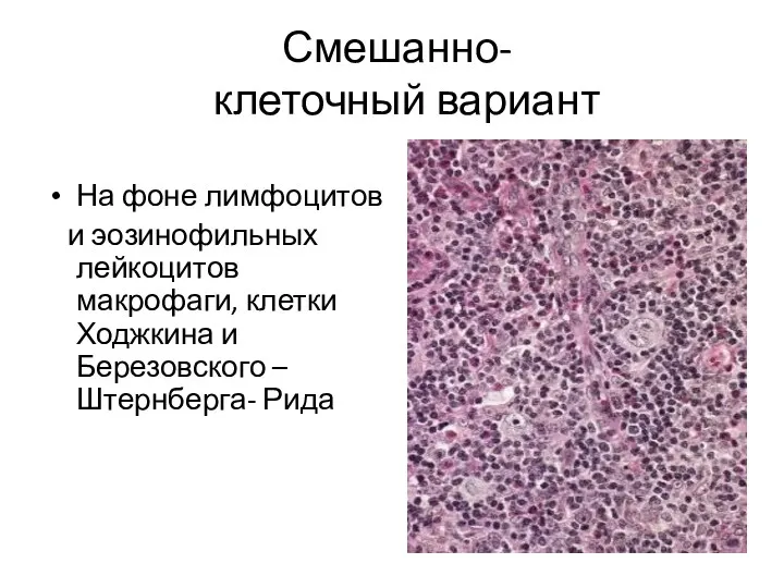 Смешанно- клеточный вариант На фоне лимфоцитов и эозинофильных лейкоцитов макрофаги, клетки Ходжкина и Березовского –Штернберга- Рида