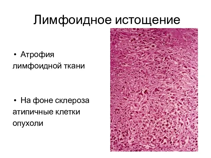 Лимфоидное истощение Атрофия лимфоидной ткани На фоне склероза атипичные клетки опухоли