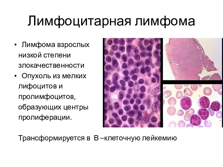 Лимфоцитарная лимфома Лимфома взрослых низкой степени злокачественности Опухоль из мелких лифоцитов и пролимфоцитов,