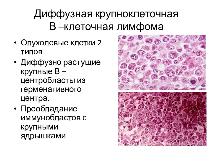 Диффузная крупноклеточная В –клеточная лимфома Опухолевые клетки 2 типов Диффузно растущие крупные В