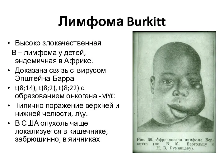 Лимфома Burkitt Высоко злокачественная В – лимфома у детей, эндемичная в Африке. Доказана