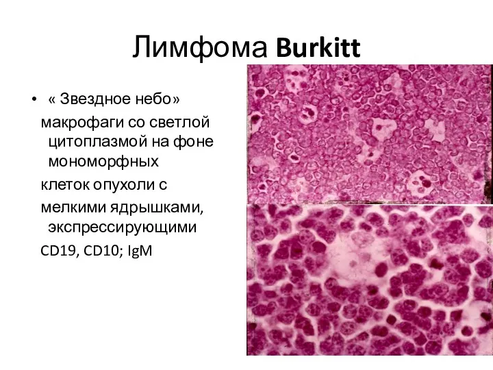 Лимфома Burkitt « Звездное небо» макрофаги со светлой цитоплазмой на фоне мономорфных клеток