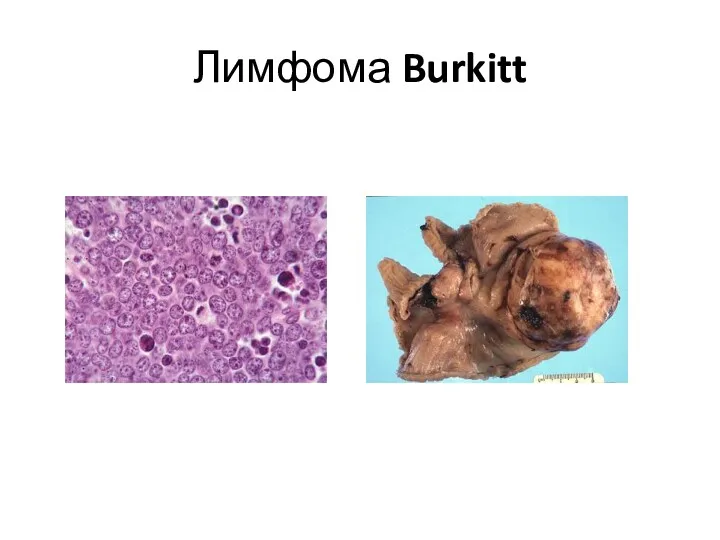 Лимфома Burkitt