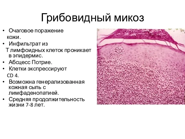 Грибовидный микоз Очаговое поражение кожи. Инфильтрат из Т лимфоидных клеток проникает в эпидермис.