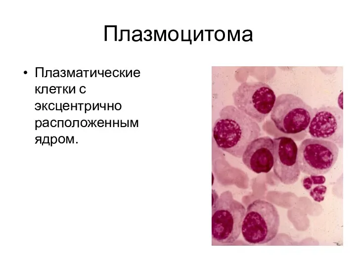 Плазмоцитома Плазматические клетки с эксцентрично расположенным ядром.