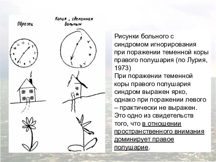 Рисунки больного с синдромом игнорирования при поражении теменной коры правого