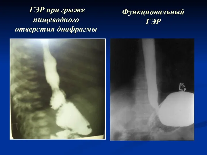 ГЭР при грыже пищеводного отверстия диафрагмы Функциональный ГЭР