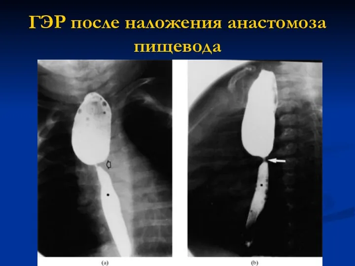 ГЭР после наложения анастомоза пищевода