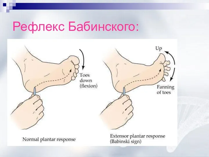 Рефлекс Бабинского: