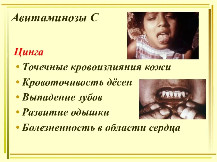 Авитаминозы С Цинга Точечные кровоизлияния кожи Кровоточивость дёсен Выпадение зубов Развитие одышки Болезненность в области сердца