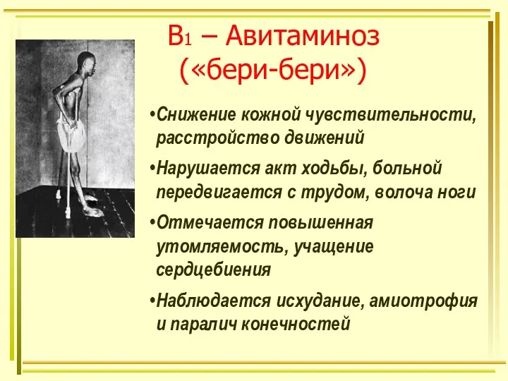 В1 – Авитаминоз («бери-бери») Снижение кожной чувствительности, расстройство движений Нарушается акт ходьбы, больной