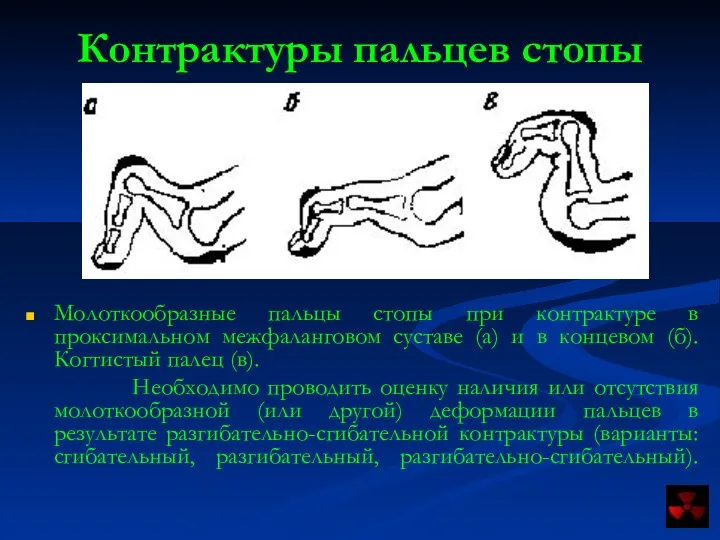Контрактуры пальцев стопы Молоткообразные пальцы стопы при контрактуре в проксимальном
