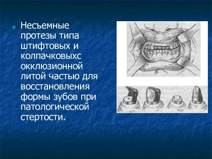 Несъемные протезы типа штифтовых и колпачковыхс окклюзионной литой частью для восстановления формы зубов при патологической стертости.