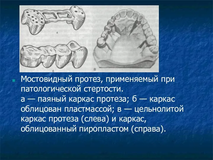 Мостовидный протез, применяемый при патологической стертости. а — паяный каркас