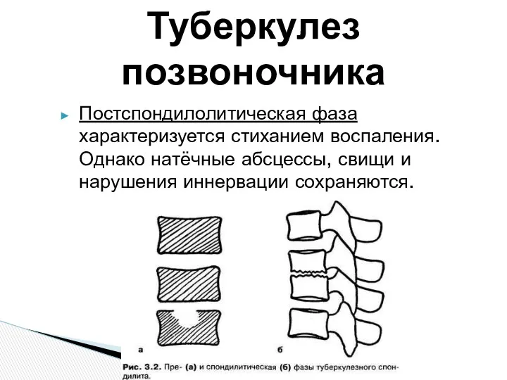 Постспондилолитическая фаза характеризуется стиханием воспаления. Однако натёчные абсцессы, свищи и нарушения иннервации сохраняются. Туберкулез позвоночника