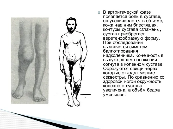 В артритической фазе появляется боль в суставе, он увеличивается в