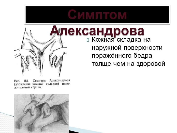 Кожная складка на наружной поверхности поражённого бедра толще чем на здоровой Симптом Александрова