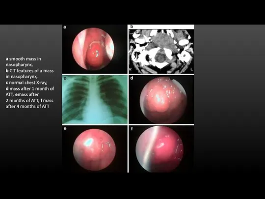 a smooth mass in nasopharynx, b C T features of