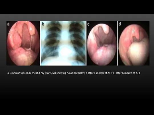 a Granular tonsils, b chest X-ray (PA view) showing no